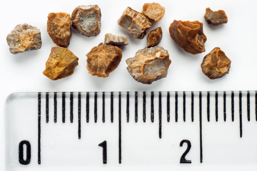 first signs of kidney stones